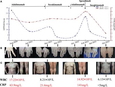 Successful treatment of acrodermatitis continua of Hallopeau coexisting with generalized pustular psoriasis with spesolimab: a case report